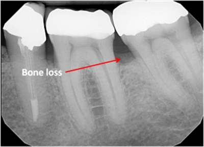 bone loss