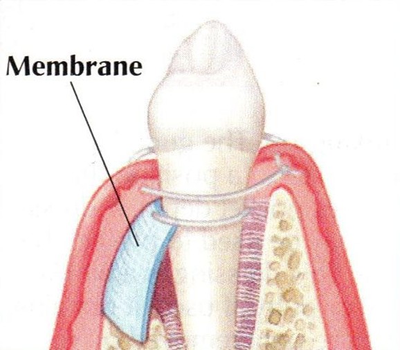 guided tissue regeneration