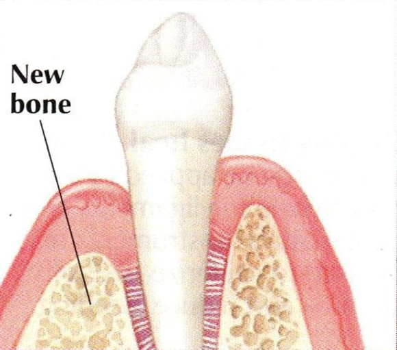 guided tissue regeneration