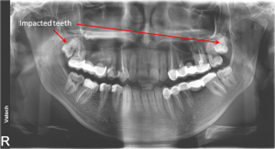 impacted teeth