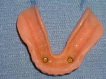 denture retention