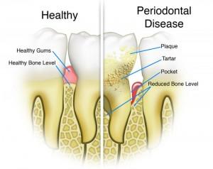 periodontal disease diagram