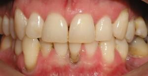 periodontal disease symptoms