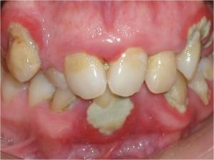 periodontal disease