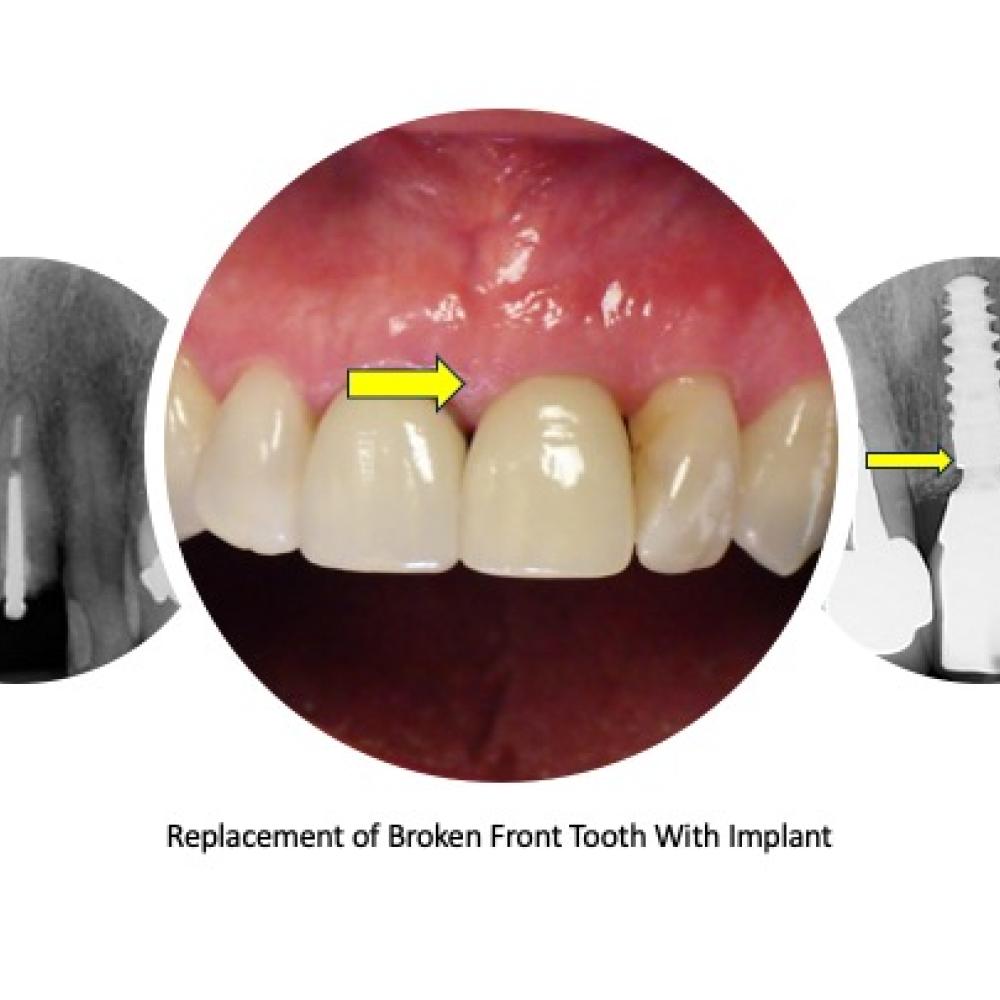 Implant 21