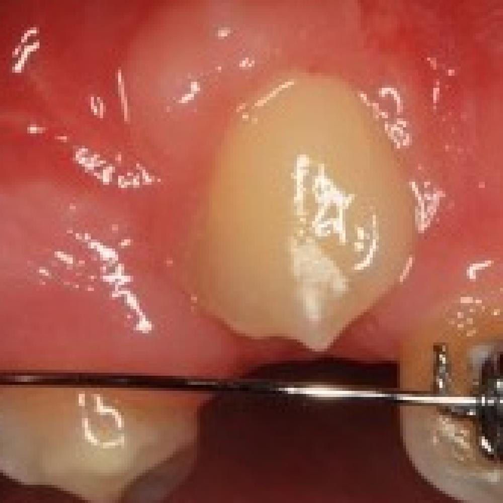 Surgical Tooth Exposure