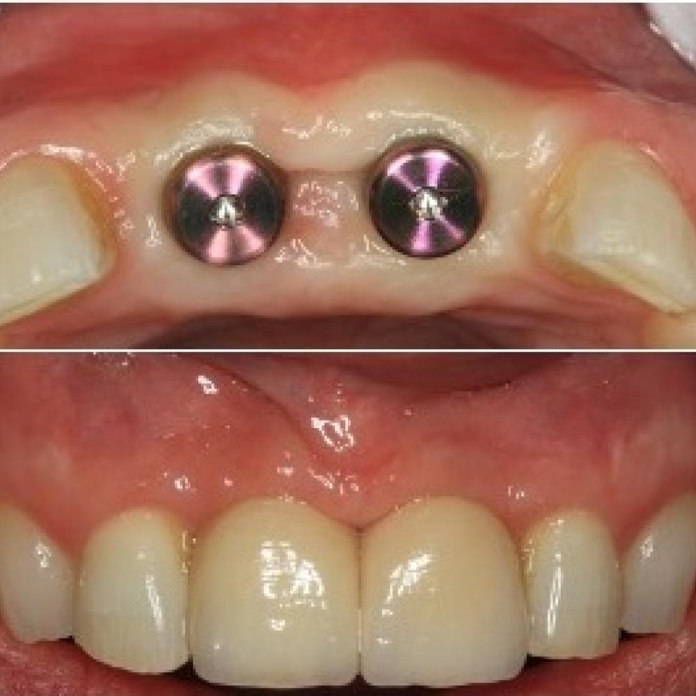 Anterior Dental Implants