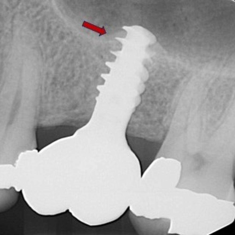 Sinus Lift