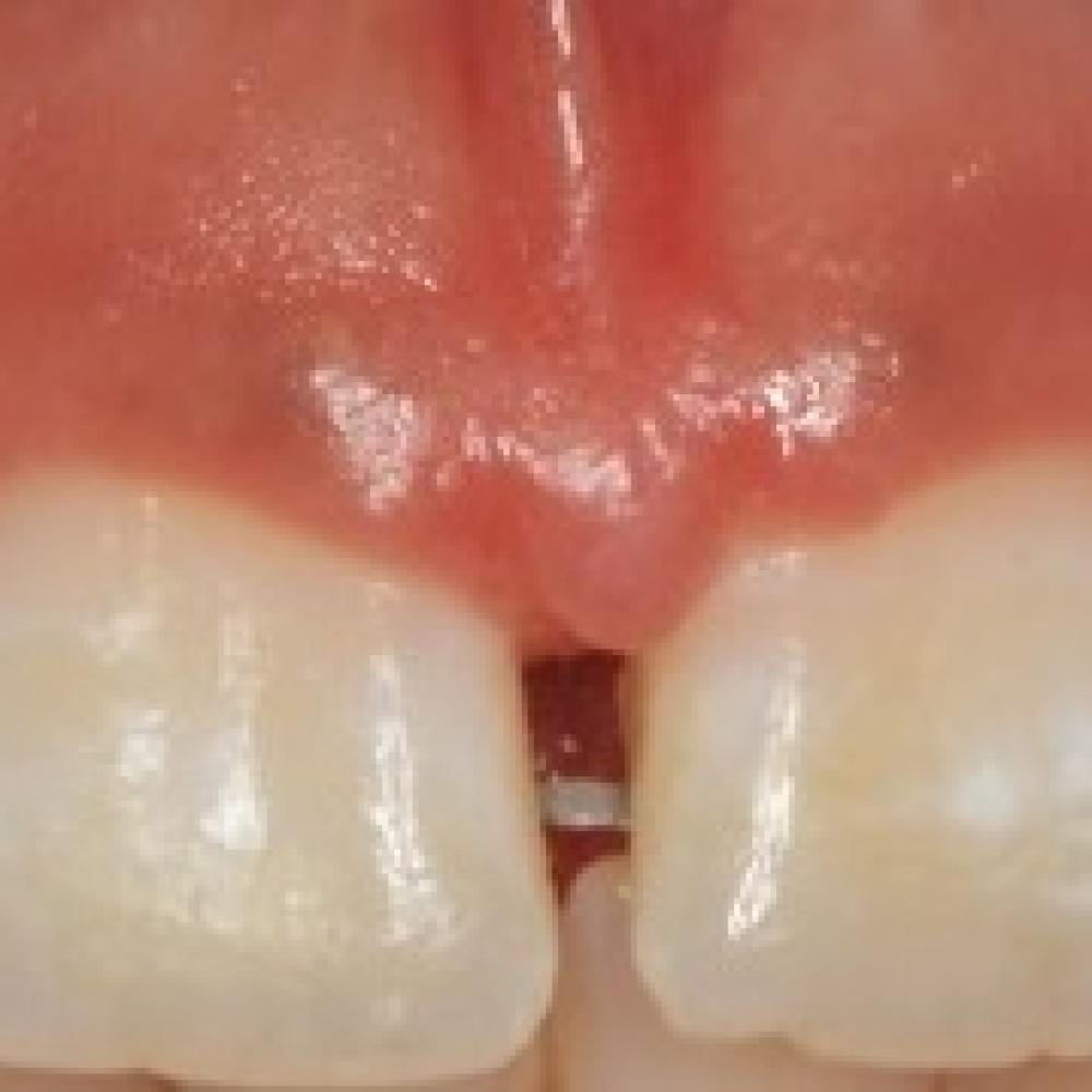 Crown Lengthening