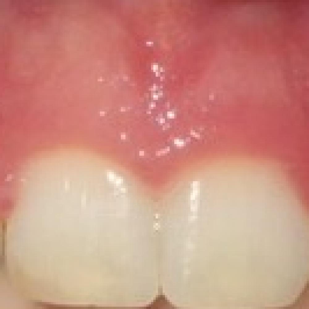 Gum Recontouring