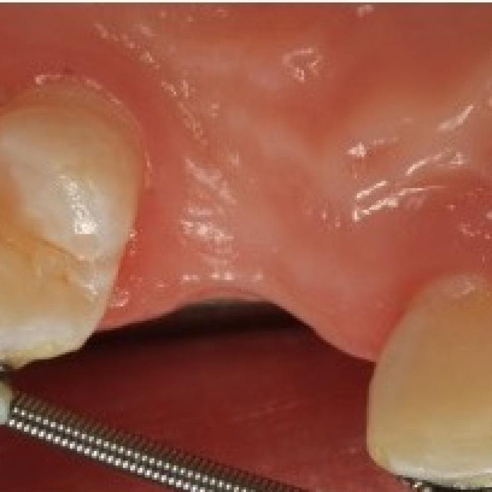 Surgical Tooth Exposure