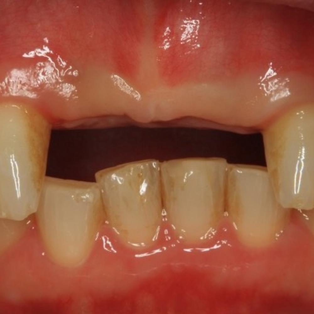 Anterior Dental Implants