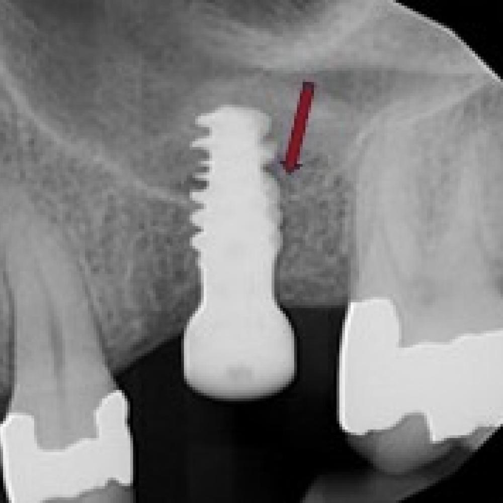 Sinus Lift 