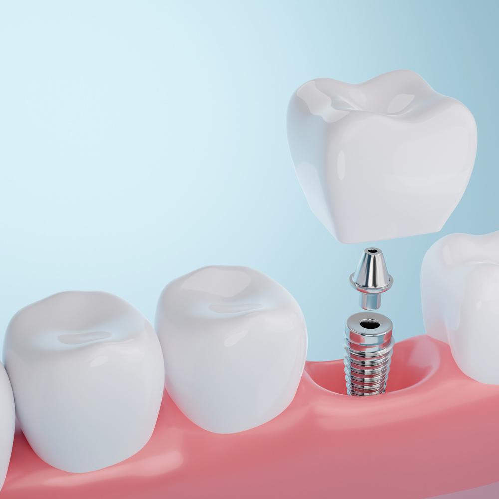 Dental Implants